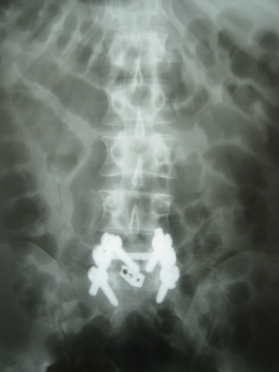 Спондилолистез