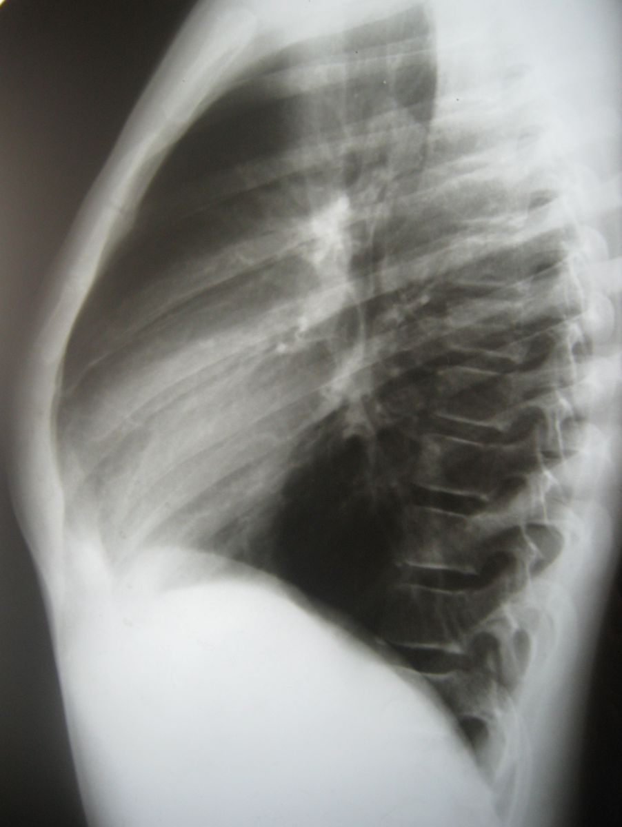 Килевидная грудь фото